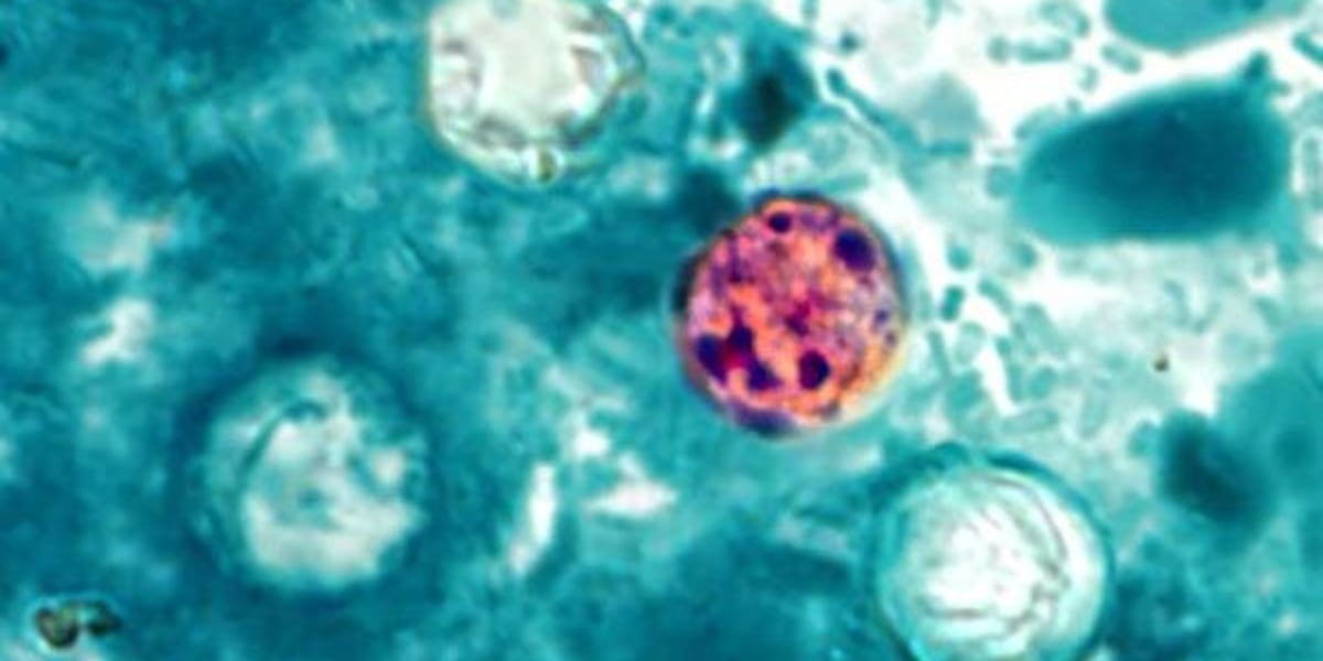 Doctor warns against waiting out Cyclospora infection as cases spread across 17 states