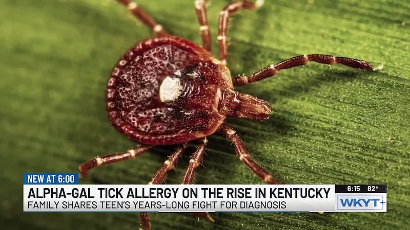 ‘It has flipped our life completely upside down’: KY teen living with tick-borne alpha-gal...